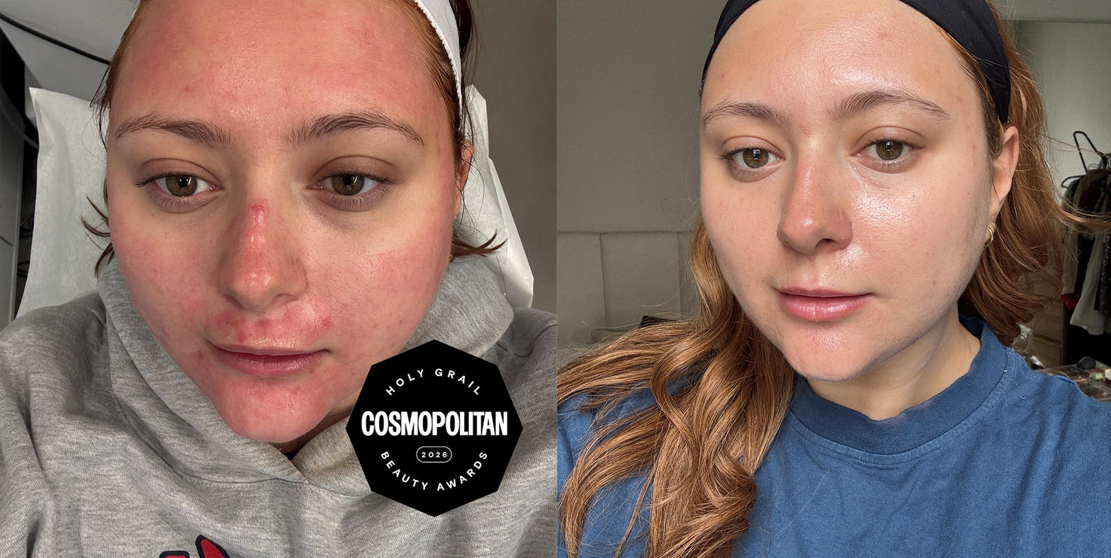 SkinPen microneedling before and after results showing improved skin texture and glow