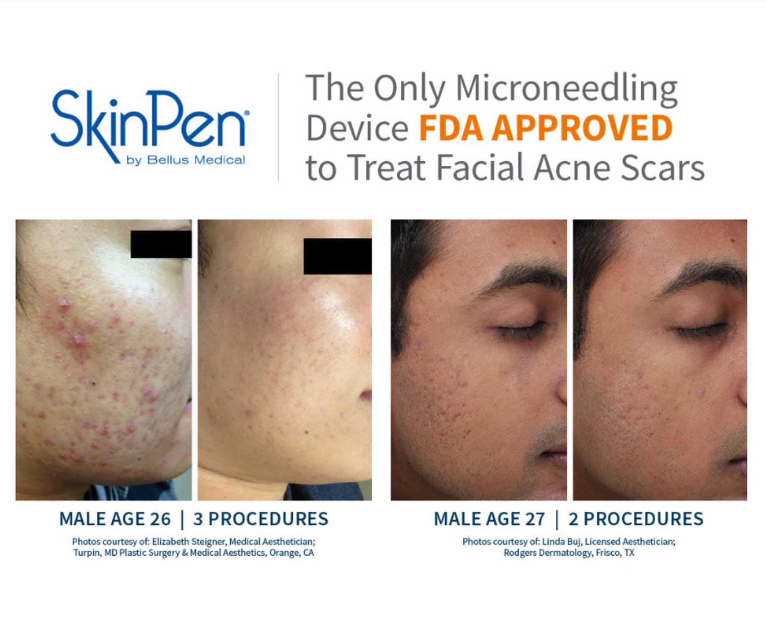 SkinPen before and after acne scars - male patients
