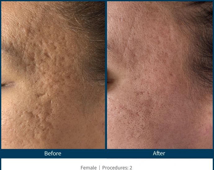 SkinPen before and after female acne scarring