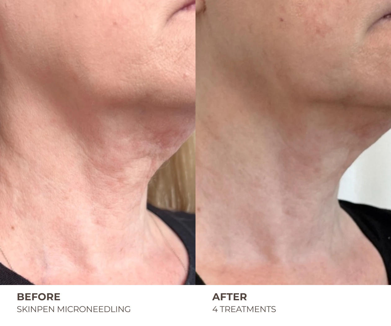 SkinPen before and after neck after 4 treatments