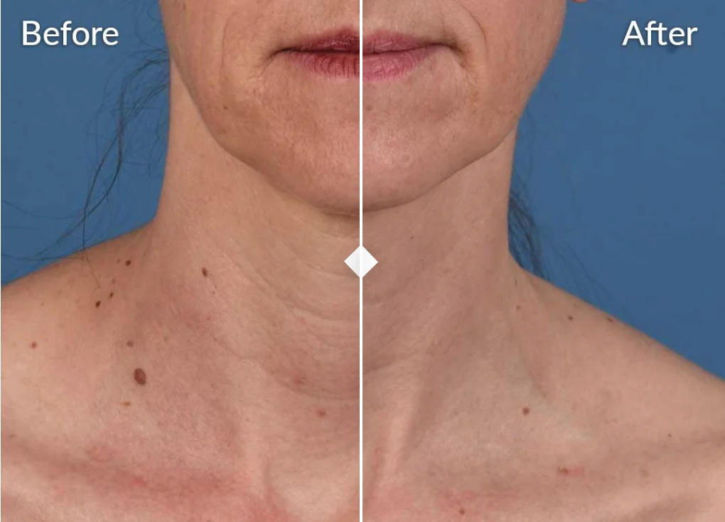 SkinPen before and after neck wrinkles