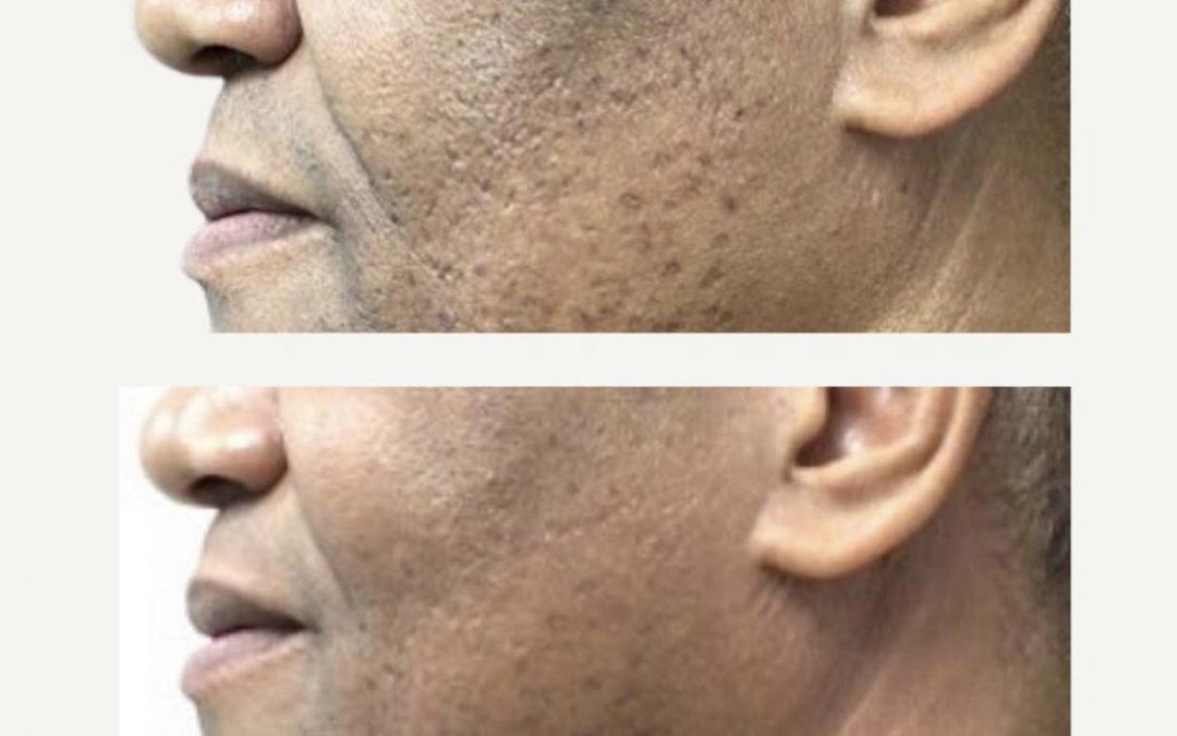 SkinPen side profile before and after texture and scars