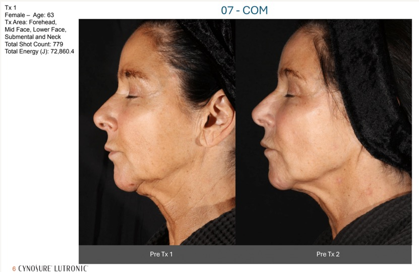 XERF clinical before and after composite - Female 63