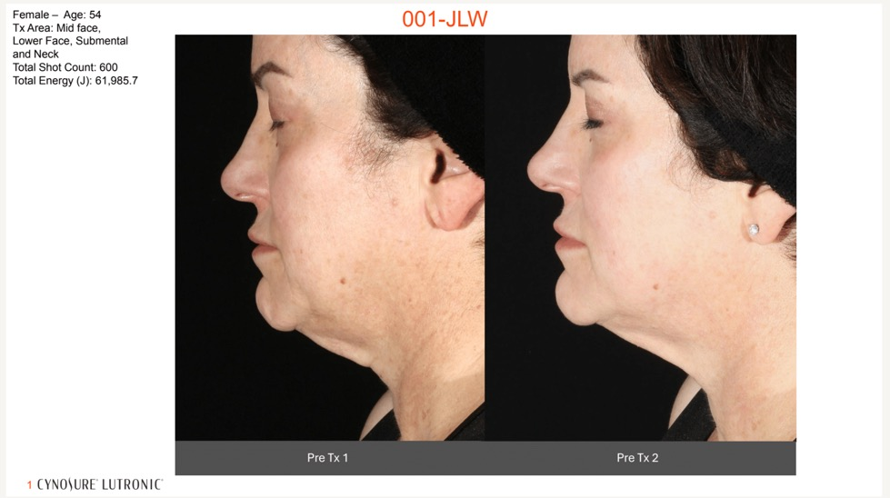 XERF clinical before and after composite - Female 54