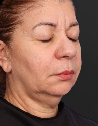 XERF clinical example composite