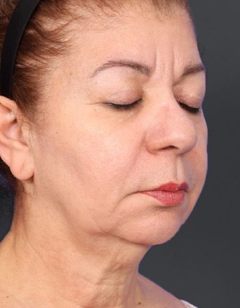 XERF after treatment — lower face and neck