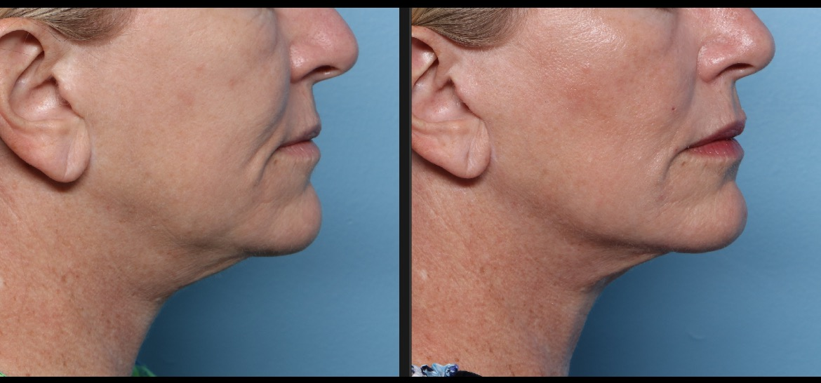 XERF jawline and neck profile before and after composite