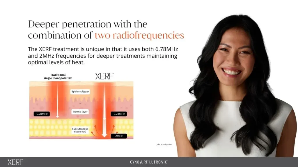 XERF dual-frequency radio-frequency treatment depth diagram