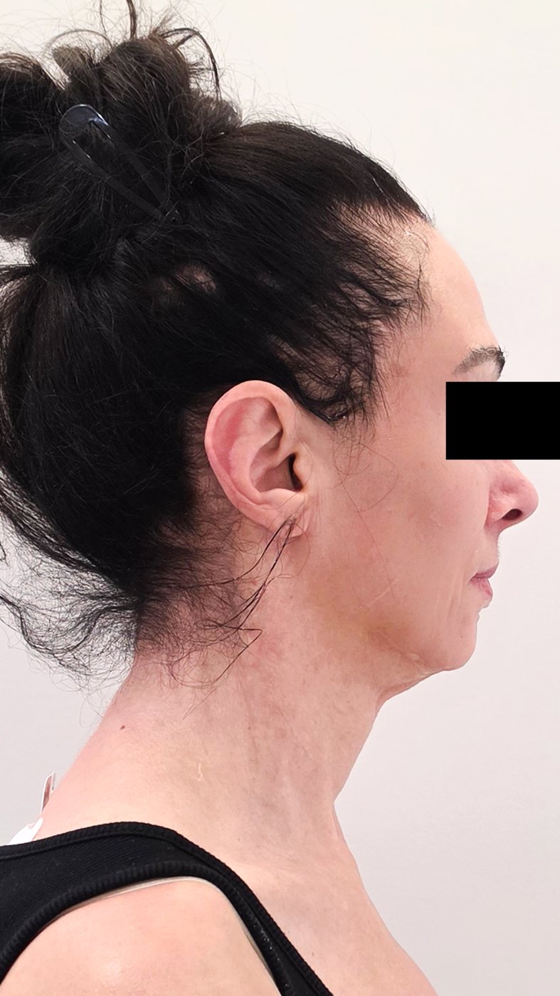 XERF before right profile