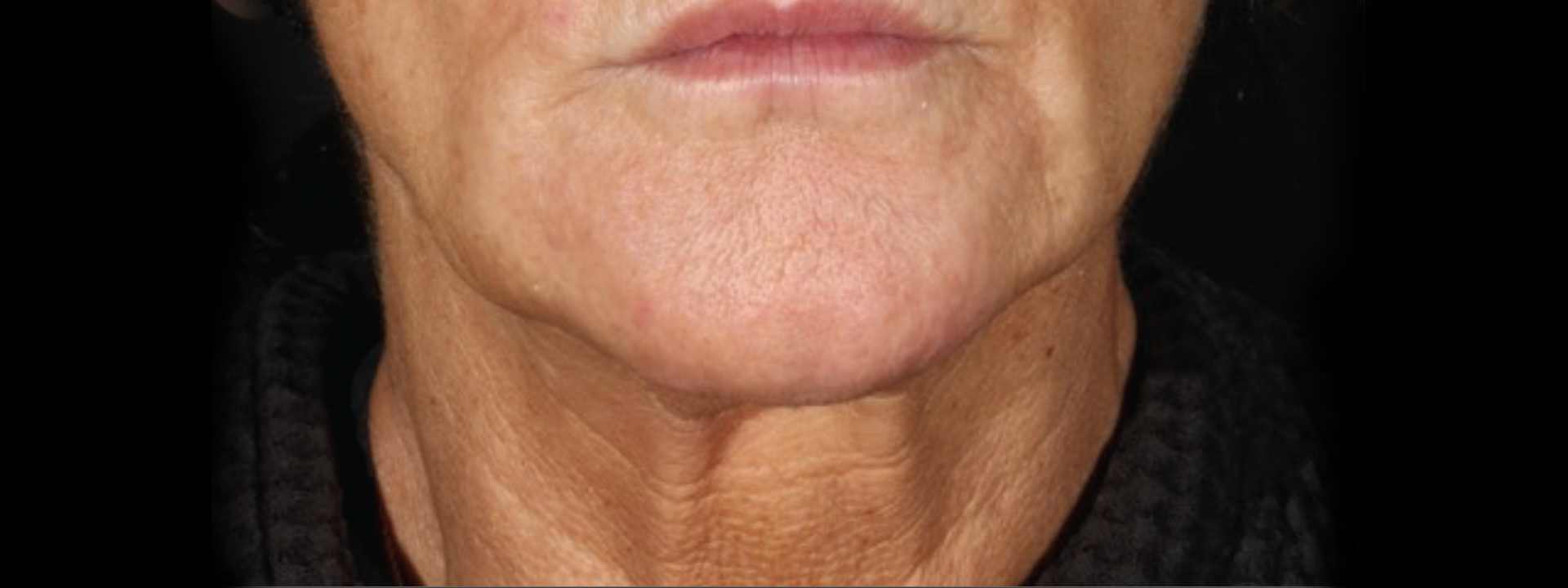 XERF after two treatments lower face and neck