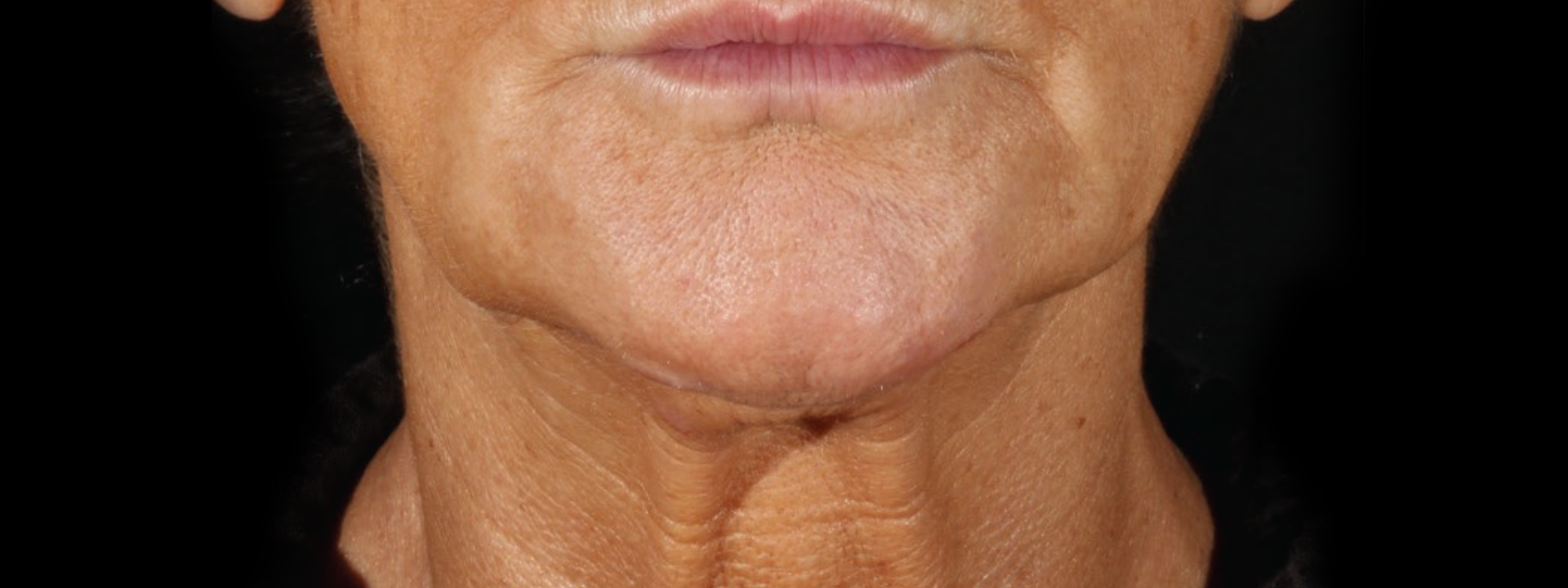 XERF before treatment lower face and neck