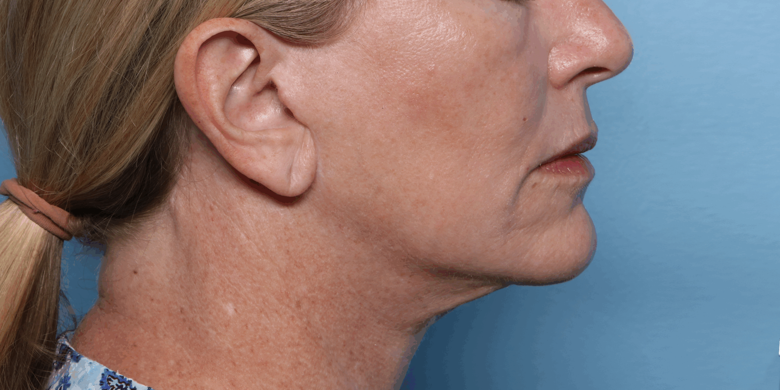 XERF after treatment profile