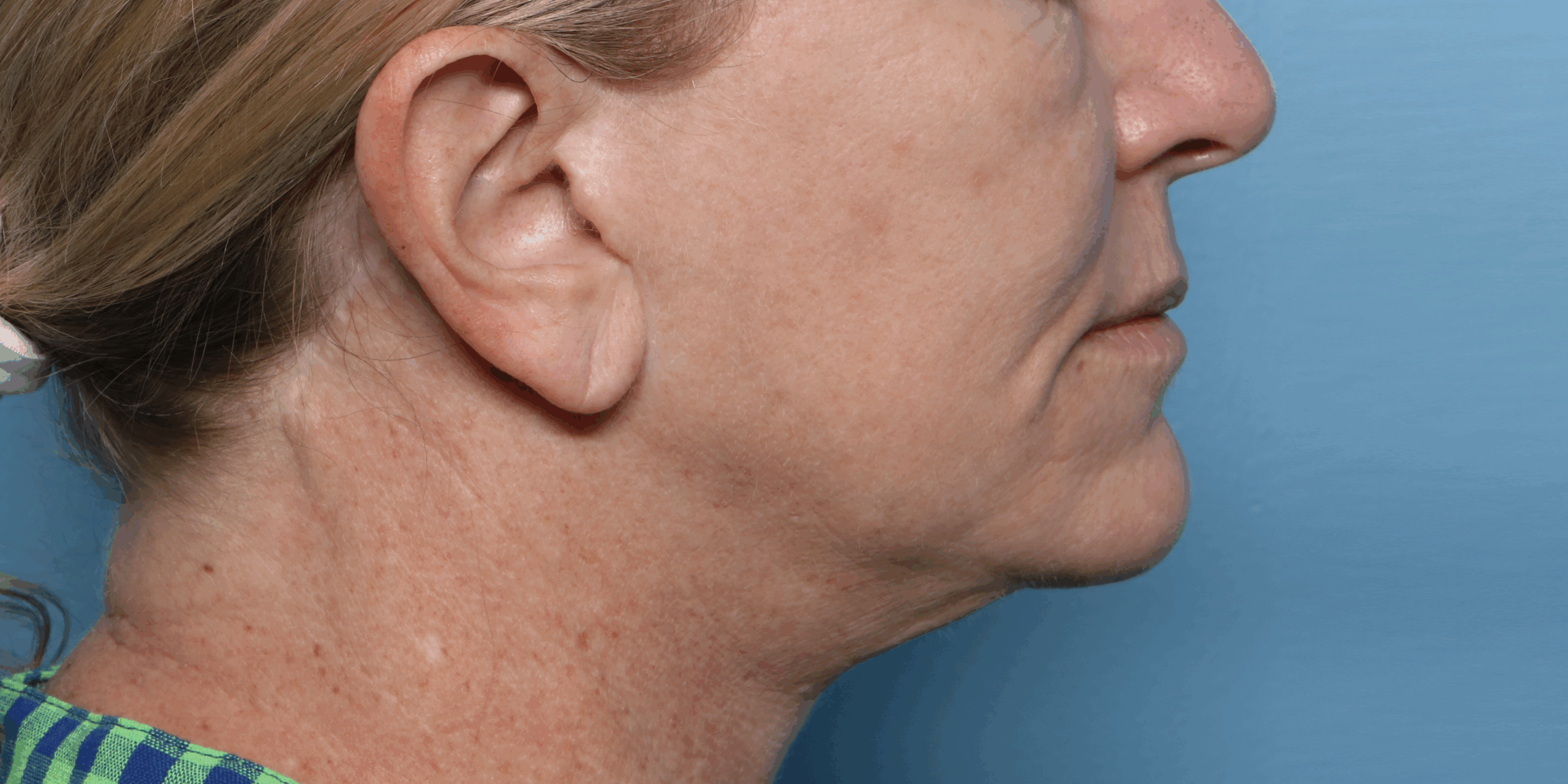 XERF before treatment profile