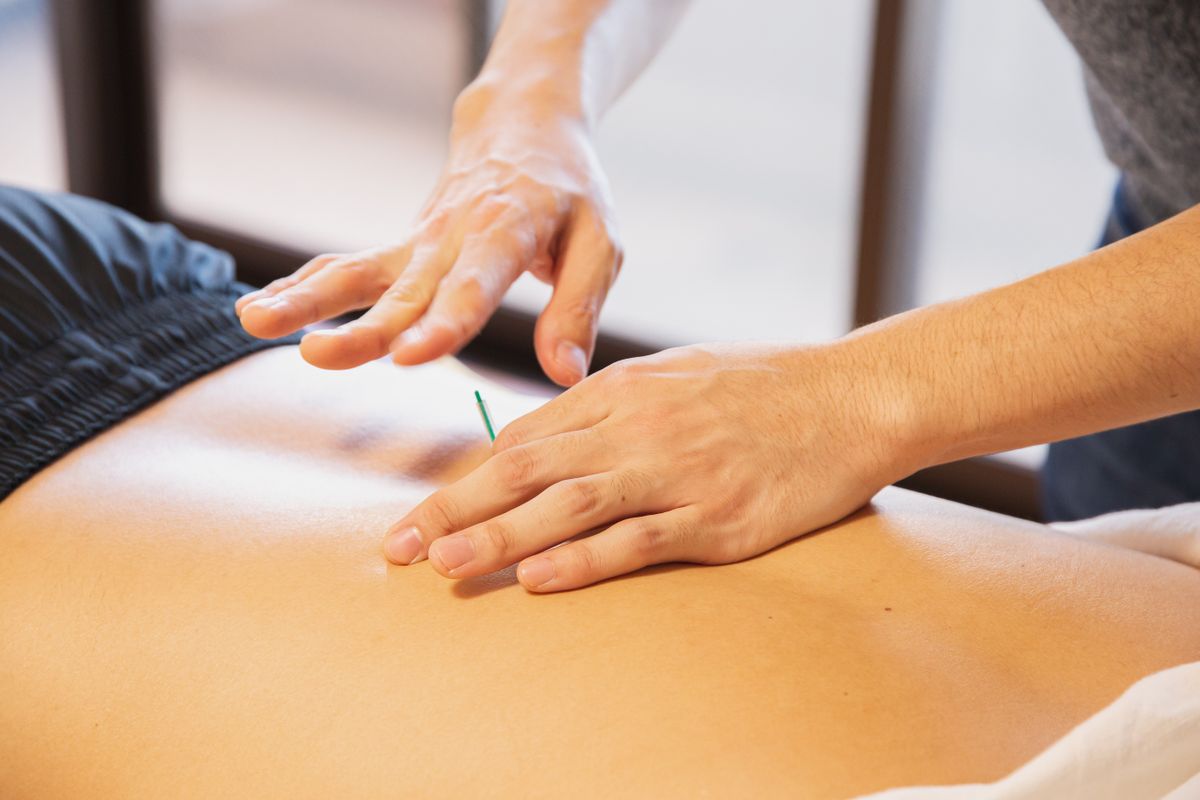 Acupuncture needles during treatment at Tri-Health
